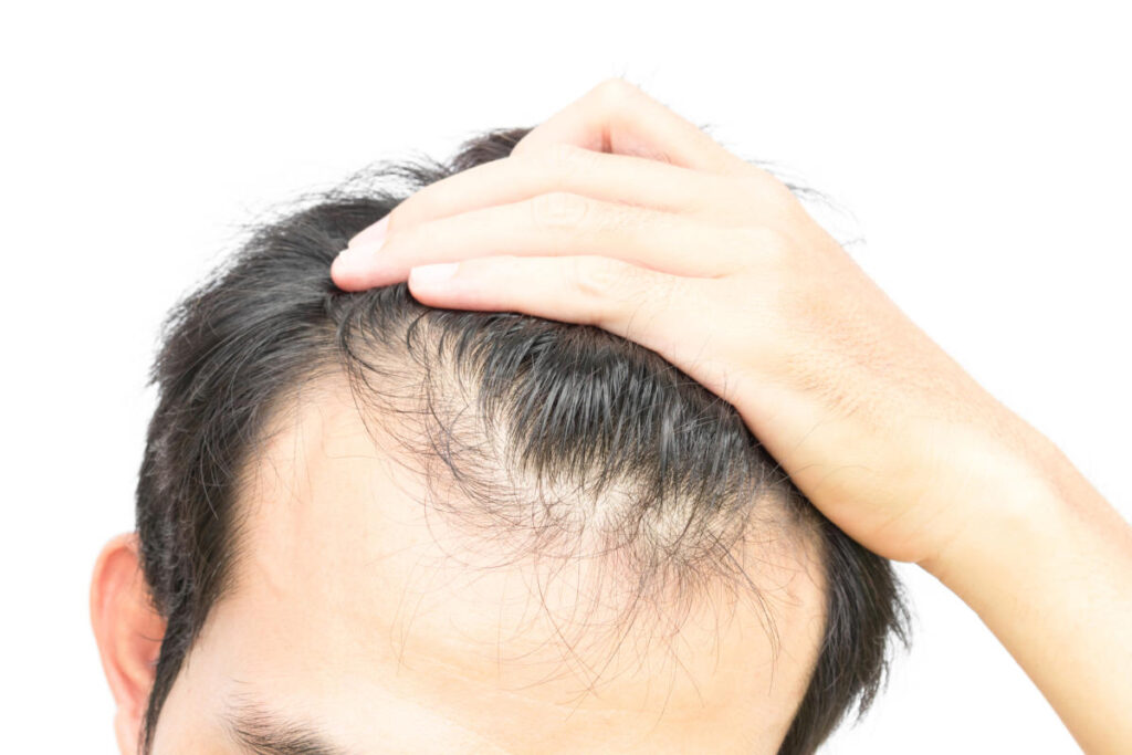 homoeopathy for hair loss